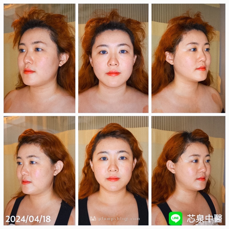 【美顏針灸體驗】台中芯泉中醫診所,什麼是美顏針灸?躺著調整臉型恢復彈性提拉膨潤全程體驗分享 - 第13張圖
