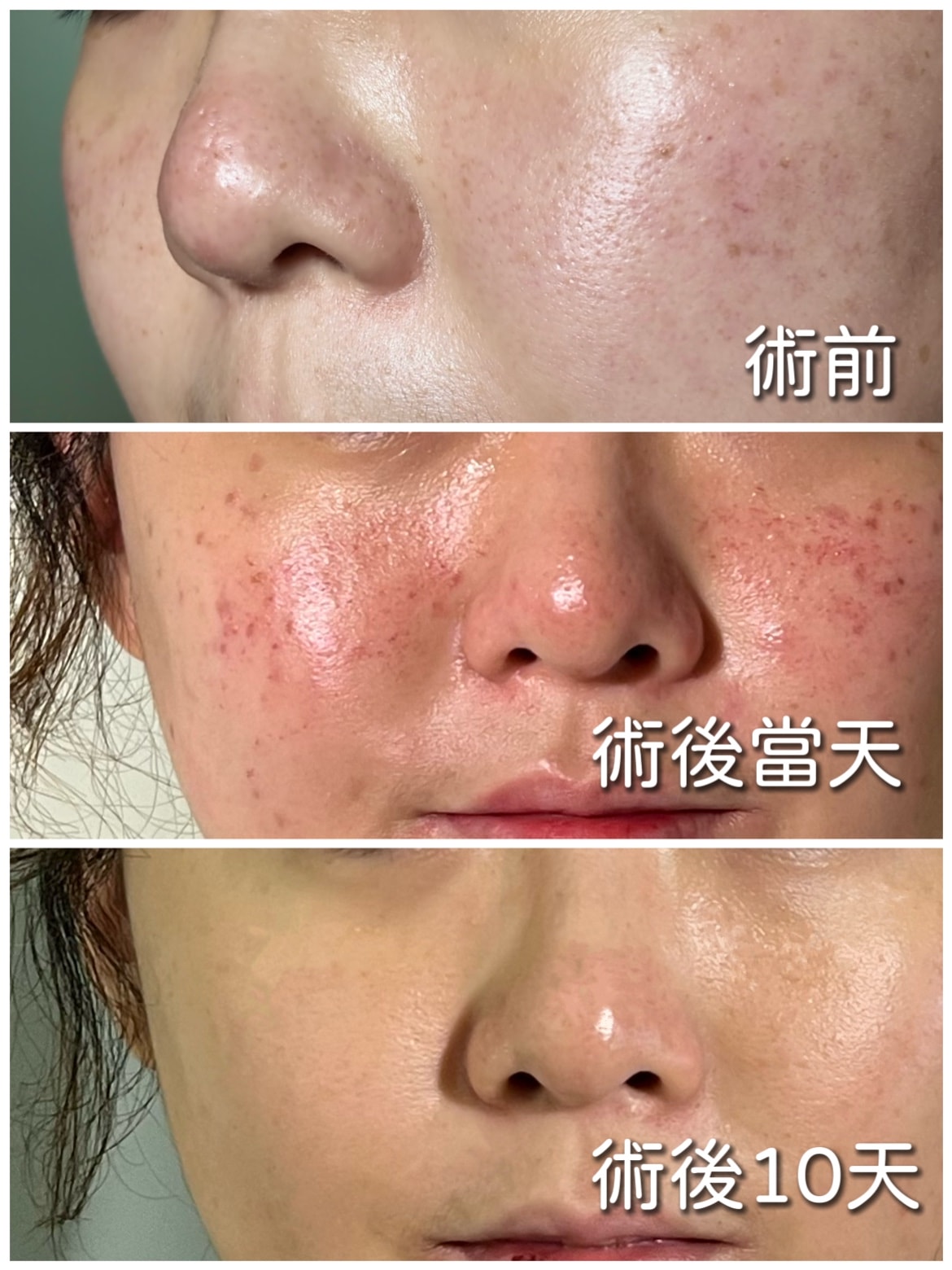 【樹林醫美】第一次做醫美,4D皮秒全臉蜂巢:暗沈、毛孔大作戰~亮立美學診所 - 第10張圖