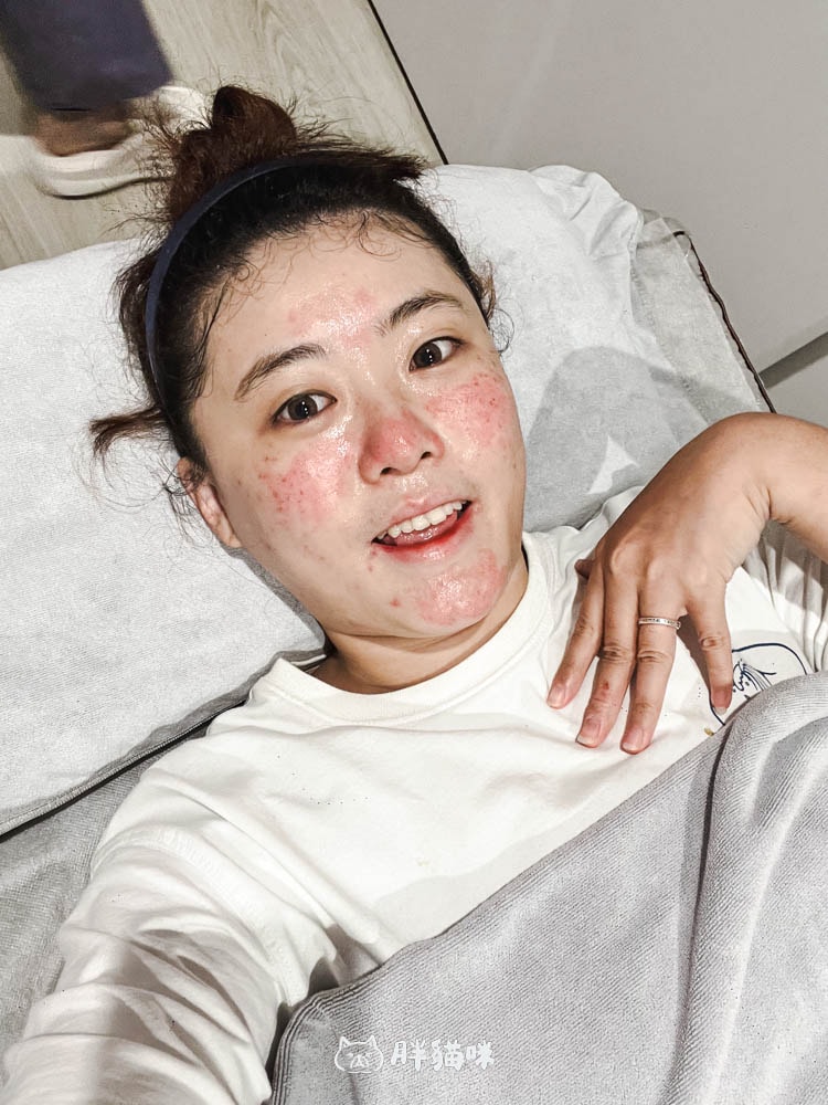 【樹林醫美】第一次做醫美,4D皮秒全臉蜂巢:暗沈、毛孔大作戰~亮立美學診所 - 第7張圖