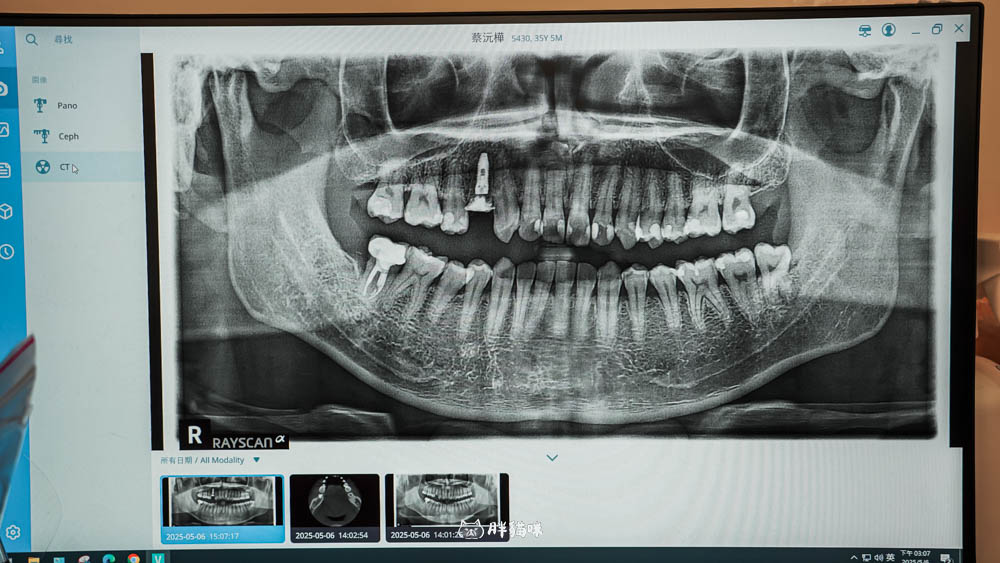 【林口植牙推薦】植牙需要花多久？超詳細人工植牙心得與5步驟流程，術後心得老實說！