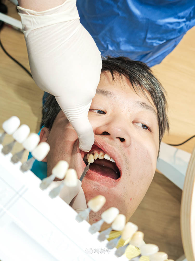 【林口植牙推薦】植牙需要花多久？超詳細人工植牙心得與5步驟流程，術後心得老實說！