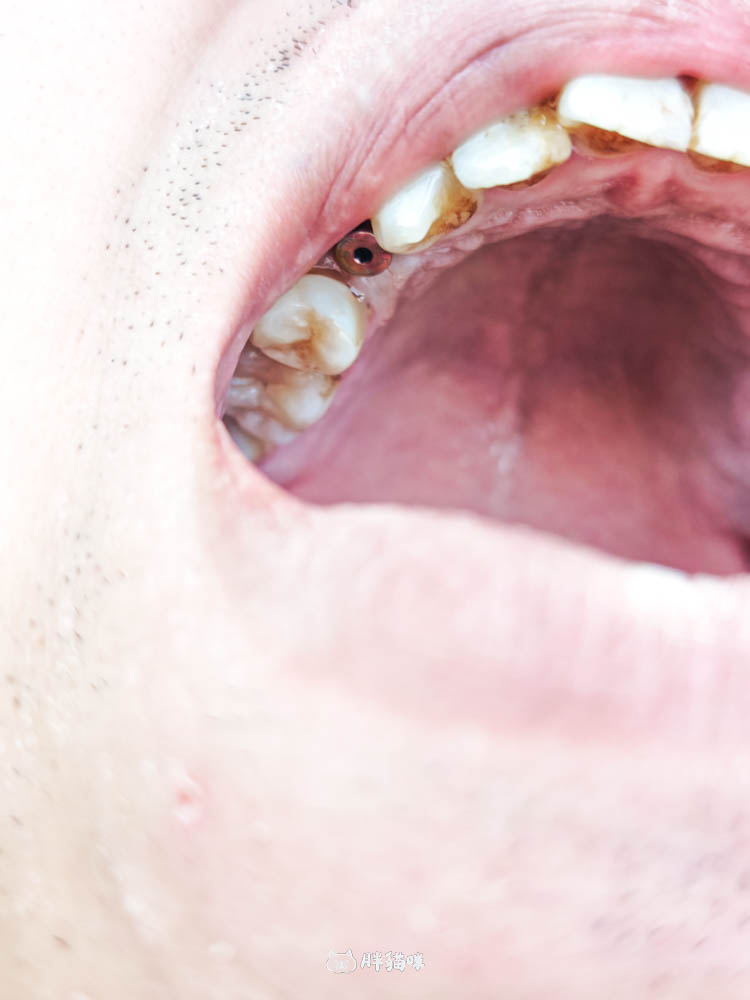 【林口植牙推薦】植牙需要花多久？超詳細人工植牙心得與5步驟流程，術後心得老實說！