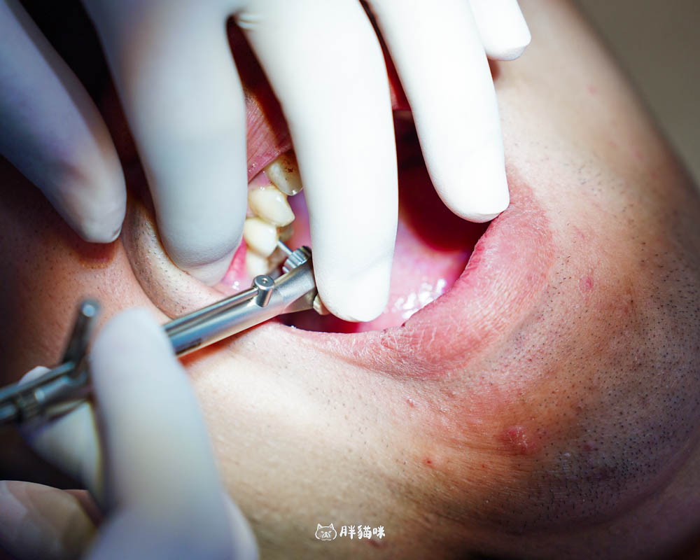 【林口植牙推薦】植牙需要花多久？超詳細人工植牙心得與5步驟流程，術後心得老實說！