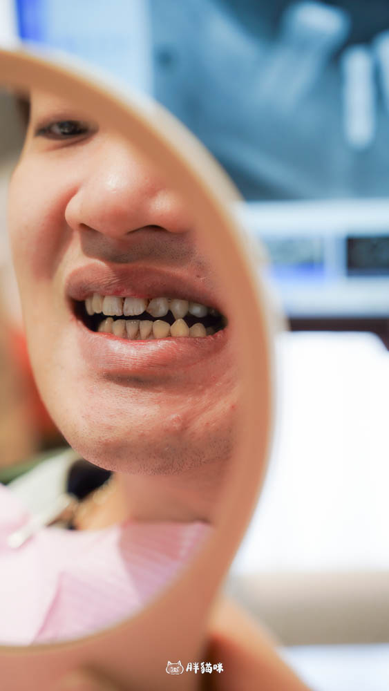 【林口植牙推薦】植牙需要花多久？超詳細人工植牙心得與5步驟流程，術後心得老實說！