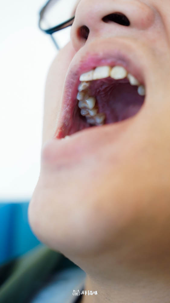 【林口植牙推薦】植牙需要花多久？超詳細人工植牙心得與5步驟流程，術後心得老實說！