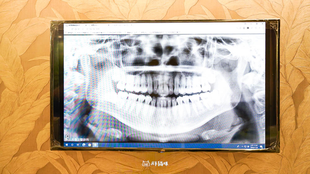 【新店牙醫推薦|大坪林牙醫 玉美學牙醫診所】洗牙不再懼怕!檢查流程感受一次分享 - 第8張圖