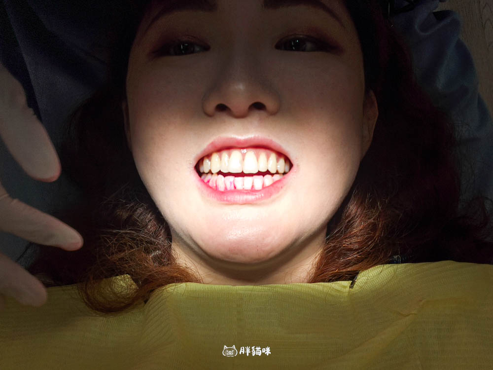 【新店牙醫推薦|大坪林牙醫 玉美學牙醫診所】洗牙不再懼怕!檢查流程感受一次分享 - 第17張圖
